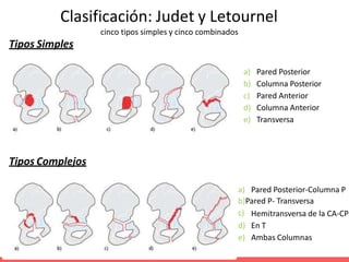 Judet Letournel Classification fx acetabulo.pptx