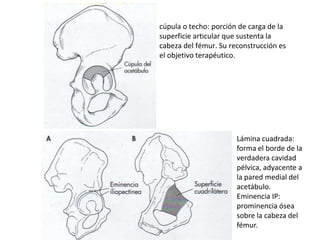 cúpula o techo: porción de carga de la
superficie articular que sustenta la
cabeza del fémur. Su reconstrucción es
el objetivo terapéutico.
Lámina cuadrada:
forma el borde de la
verdadera cavidad
pélvica, adyacente a
la pared medial del
acetábulo.
Eminencia IP:
prominencia ósea
sobre la cabeza del
fémur.
 