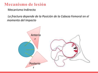 Mecanismo Indirecto
La fractura depende de la Posición de la Cabeza Femoral en el
momento del Impacto
Anterio
r
Posterio
r
Mecanismo de lesión
 