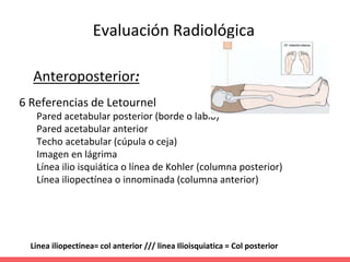 Evaluación Radiológica
Anteroposterior:
6 Referencias de Letournel
Pared acetabular posterior (borde o labio)
Pared acetabular anterior
Techo acetabular (cúpula o ceja)
Imagen en lágrima
Línea ilio isquiática o línea de Kohler (columna posterior)
Línea iliopectínea o innominada (columna anterior)
Linea iliopectinea= col anterior /// linea Ilioisquiatica = Col posterior
 