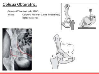 Oblicua Obturatriz:
Giro en 45° hacia el lado SANO
Visión: Columna Anterior (Línea Iliopectínea)
Borde Posterior
 