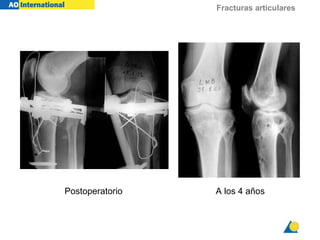 Fracturas articulares
A los 4 añosPostoperatorio
 