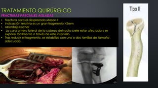TRATAMIENTO QUIRÚRGICO
FRACTURAS PARCIALES AISLADAS
• Fractura parcial desplazada Mason II
• Indicación relativa es un gran fragmento >2mm
• Abordaje kocher
• La cara antero lateral de la cabeza del radio suele estar afectada y se
expone fácilmente a través de este intervalo.
• Tras reducir el fragmento, se estabiliza con uno o dos tornillos de tamaño
adecuado.
 
