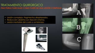 TRATAMIENTO QUIRÚRGICO
FRACTURAS PARCIALES COMO PARTE DE UNA LESIÓN COMPLEJA
• Lesión compleja, fragmentos desplazados.
• Reducción abierta con fijación interna.
• Lesión inestable del codo o antebrazo
 