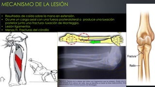 MECANISMO DE LA LESIÓN
• Resultados de caída sobre la mano en extensión.
• Ocurre un carga axial con una fuerza posterolateral o produce una luxación
posterior junto una fractura- luxación de Monteggia.
• Lesión ligamentos
• Menos Fr. Fracturas del cóndilo
 