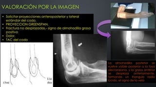 VALORACIÓN POR LA IMAGEN
• Solicitar proyecciones anteroposterior y lateral
estándar del codo.
• PROYECCION GREENSPAN.
• Fractura no desplazadas.- signo de almohadilla grasa
positivo
• Dolor.
• TAC del codo
En una radiografía lateral
estricta bien realizada, la banda
grasa anterior puede aparecer
como una área pequeña radio
lucida anterior al humero distal.
La almohadilla posterior se
vuelve visible posterior a la fosa
olecraneana, y la grasa anterior
se desplaza anteriormente,
formando un triangulo radio
lúcido, el signo de la vela
 