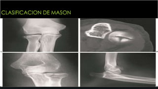 CLASIFICACION DE MASON
 