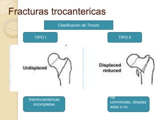 Fracturas trocantericas
                     Clasificacion de Tronzo


       TIPO I                                      TIPO II




                                               No
    Intertrocantericas
                                               conminutas, desplaz
       incompletas
                                               adas o no
 