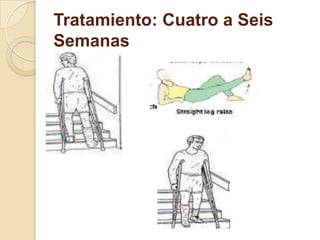 Tratamiento: Cuatro a Seis
Semanas
 