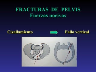 FRACTURAS  DE  PELVIS Fuerzas nocivas Cizallamiento Fallo vertical 