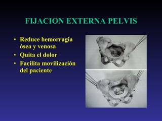 Reduce hemorragia ósea y venosa Quita el dolor Facilita movilización del paciente FIJACION EXTERNA PELVIS 