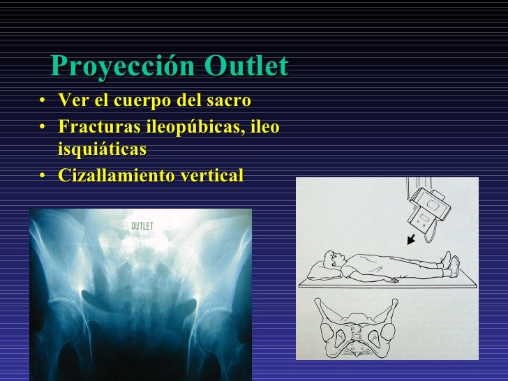 Fx complejas pelvis_