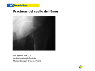 Femoral neck fractures
Fracturas del cuello del fémur
Piet de Boer York U.K.
Ian Harris Adelaide Australia
Mariusz Bonczar, Crocow , Poland
 
