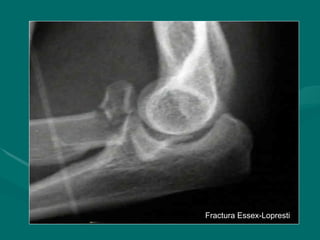 Fractura Essex-Lopresti
Fractura Essex-Lopresti
 