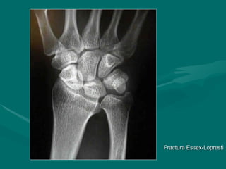 Fractura Essex-Lopresti
Fractura Essex-Lopresti
 