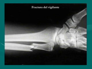 Fractura del vigilante
Fractura del vigilante
 