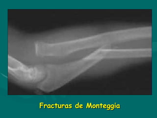 Fracturas de Monteggia
Fracturas de Monteggia
 