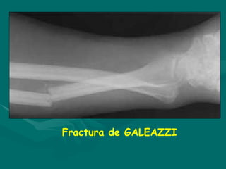 Fractura de GALEAZZI
 