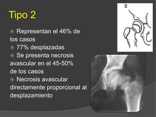 Tipo 2
 Representan el 46% de
los casos
 77% desplazadas
 Se presenta necrosis
avascular en el 45-50%
de los casos
 Necrosis avascular
directamente proporcional al
desplazamiento
 