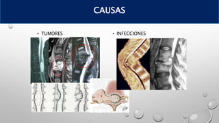 • TUMORES • INFECCIONES
CAUSAS
 