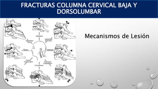 Mecanismos de Lesión
FRACTURAS COLUMNA CERVICAL BAJA Y
DORSOLUMBAR
 