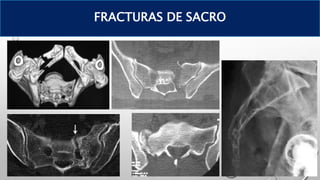 FRACTURAS DE SACRO
 