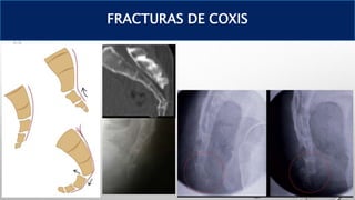 FRACTURAS DE COXIS
 