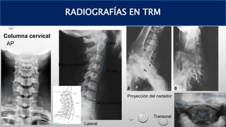 Columna cervical
RADIOGRAFÍAS EN TRM
Muro posterior
3 mm
5 mm
Muro anterior
Atlas
Odontoides
Axis
AP
Lateral
Proyección del nadador
Transoral
 
