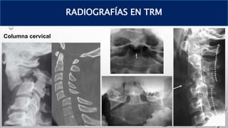 Columna cervical
RADIOGRAFÍAS EN TRM
 
