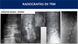 Columna toraco - lumbar
RADIOGRAFÍAS EN TRM
 