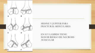 MEHNE Y JUPITER PARA
FRACTURAS ARTICULARES
EN H Y LAMBDA TIENE
MAYOR RIESGO DE NECROSIS
AVASCULAR
 