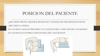 POSICION DEL PACIENTE
_DECUBITO PRONO (MEJOR EXPOSICION Y MANEJO DE FRAGMENTOS OSEOS)
_DECUBITO LATERAL
EN LOS DOS CASOS SE PREFIERE UNA FLEXION DEL CODO MAYOR A 90 GRADOS
EN LOS DOS ES FACTIBLE OSTEOTOMIA DEL OLECRANON
 