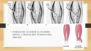 • FORMAS DE ACCEDER AL HUMERO
DISTAL A TRAVES DEL TENDON DEL
TRICEPS
 