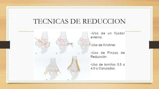 TECNICAS DE REDUCCION
 