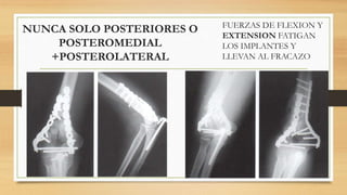 NUNCA SOLO POSTERIORES O
POSTEROMEDIAL
+POSTEROLATERAL
FUERZAS DE FLEXION Y
EXTENSION FATIGAN
LOS IMPLANTES Y
LLEVAN AL FRACAZO
 
