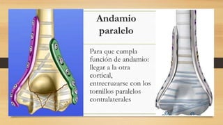 Andamio
paralelo
Para que cumpla
función de andamio:
llegar a la otra
cortical,
entrecruzarse con los
tornillos paralelos
contralaterales
 