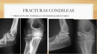 FRACTURAS CONDILEAS
• PRINCION DE TORNILLO INTERFRAGMENTARIO
 