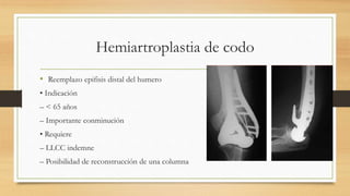 Hemiartroplastia de codo
• Reemplazo epifisis distal del humero
• Indicación
– < 65 años
– Importante conminución
• Requiere
– LLCC indemne
– Posibilidad de reconstrucción de una columna
 