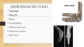 ARTRODESIS DE CODO
• Salvataje
– Post Fx
• Dolor
• Inestabilidad
• Déficit stock óseo
• Infección crónica
• Falla TEA
 