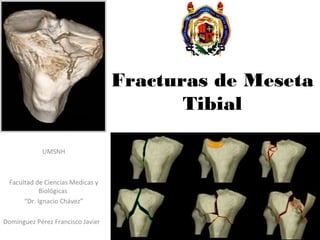 Fracturas de Meseta
Tibial
UMSNH
Facultad de Ciencias Medicas y
Biológicas
“Dr. Ignacio Chávez”
Domínguez Pérez Francisco Javier
 