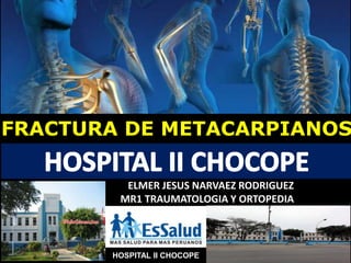 HOSPITAL II CHOCOPE
FRACTURA DE METACARPIANOS
ELMER JESUS NARVAEZ RODRIGUEZ
MR1 TRAUMATOLOGIA Y ORTOPEDIA
 