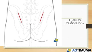 FIJACION
TRANS-ILIACA