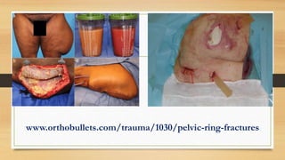www.orthobullets.com/trauma/1030/pelvic-ring-fractures