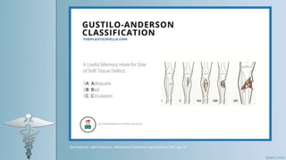 Epomedicine. Open fractures : Mnemonics [Internet]. Epomedicine; 2017 Apr 17
 