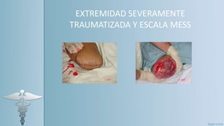 EXTREMIDAD SEVERAMENTE
TRAUMATIZADA Y ESCALA MESS
 