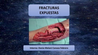 FRACTURAS
EXPUESTAS
Interna: Dania Melani Canaza Febrero
 
