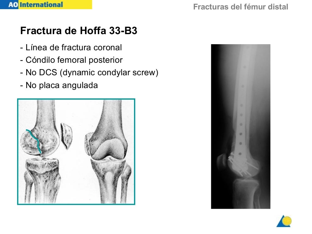 Fx Femur Distal Fx Femur Distal