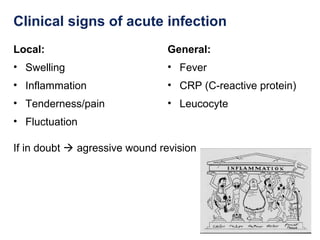 Clinical signs of acute infection
Local:
• Swelling
• Inflammation
• Tenderness/pain
• Fluctuation
If in doubt  agressive wound revision
General:
• Fever
• CRP (C-reactive protein)
• Leucocyte
 