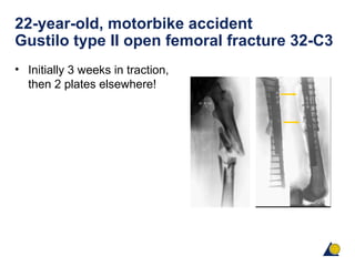 22-year-old, motorbike accident
Gustilo type II open femoral fracture 32-C3
• Initially 3 weeks in traction,
then 2 plates elsewhere!
 