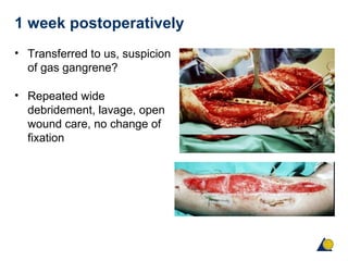 1 week postoperatively
• Transferred to us, suspicion
of gas gangrene?
• Repeated wide
debridement, lavage, open
wound care, no change of
fixation
 